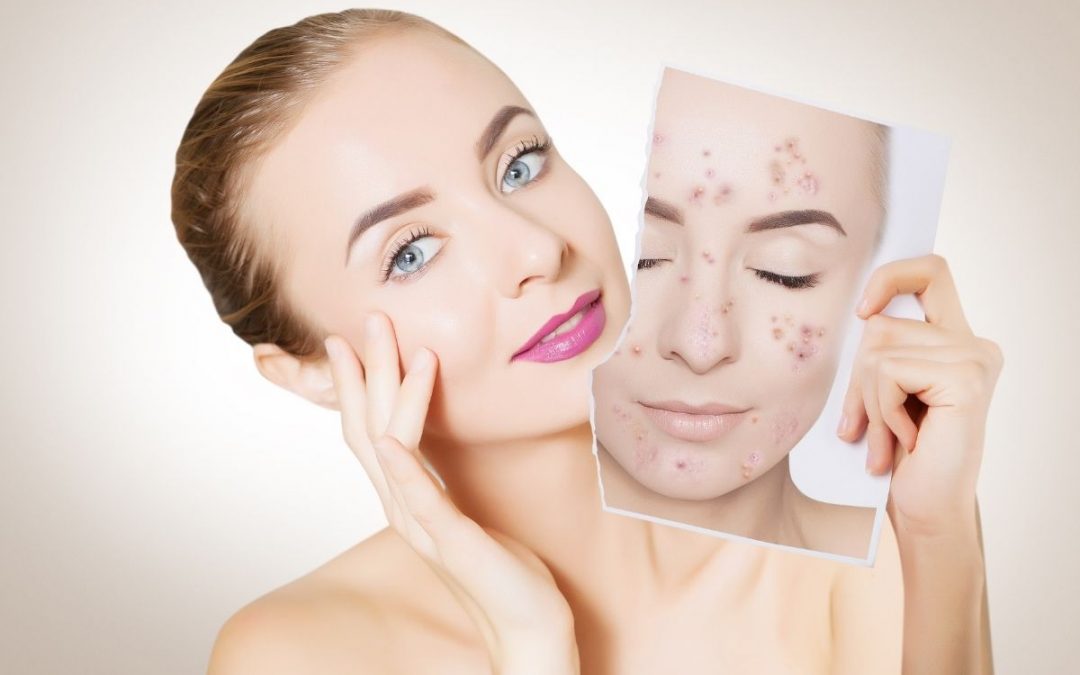 Trattamento acne: come risolvere il problema