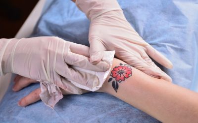 Rimozione tatuaggi, come viene effettuata