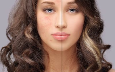 Cicatrici acne, come ridurle con la medicina estetica