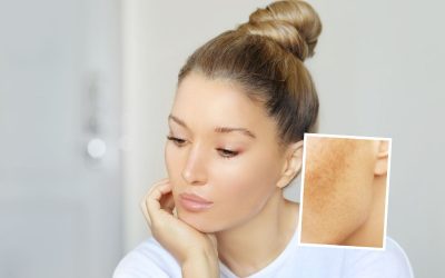 Rimozione macchie solari sulla pelle, le tecniche più utilizzate