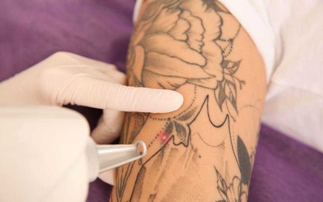 Laser tatuaggi: la soluzione efficace per eliminare i tatuaggi indesiderati