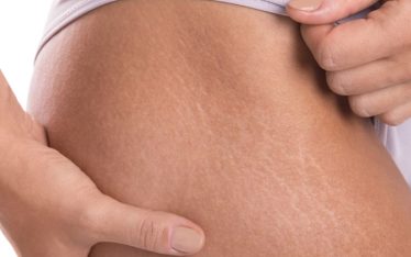 carbossiterapia smagliature