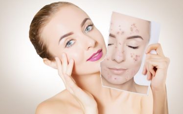 donna con acne prima e dopo